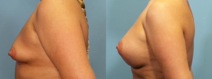 Before & After Breast Augmentation Case 311 Left Side View in Portland, OR