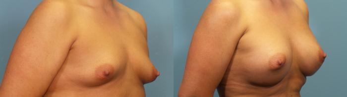 Before & After Breast Augmentation Case 311 Right Oblique View in Portland, OR