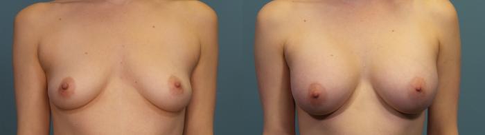 Before & After Breast Augmentation Case 318 Front View in Portland, OR
