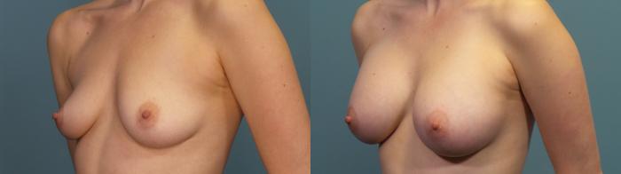 Before & After Breast Augmentation Case 318 Left Oblique View in Portland, OR