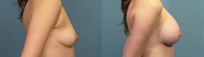 Before & After Breast Augmentation Case 318 Right Side View in Portland, OR