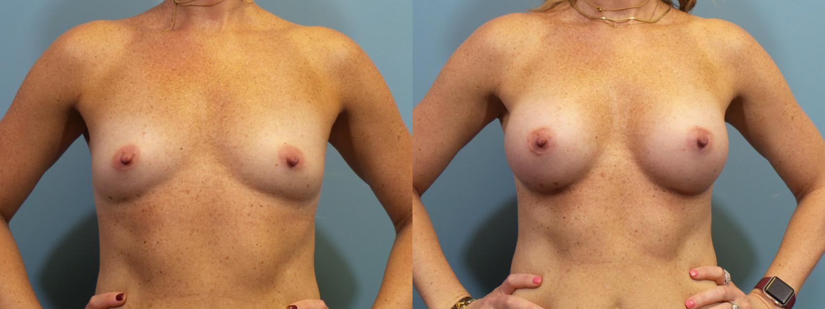 Before & After Breast Augmentation Case 372 Front View in Portland, OR