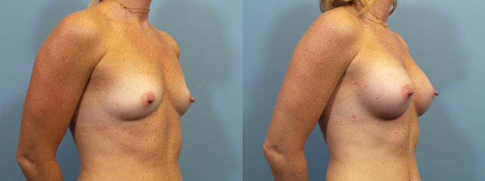 Before & After Breast Augmentation Case 372 Left Oblique View in Portland, OR