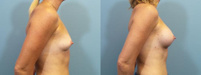 Before & After Breast Augmentation Case 372 Left Side View in Portland, OR