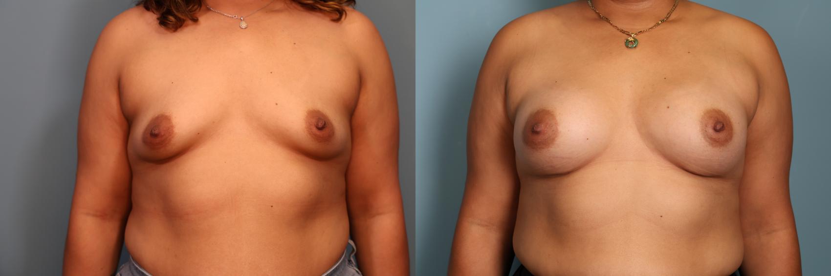 Before & After Breast Augmentation Case 374 Front View in Portland, OR
