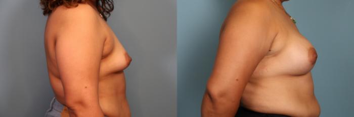 Before & After Breast Augmentation Case 374 Left Side View in Portland, OR