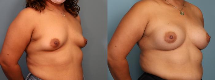 Before & After Breast Augmentation Case 374 Right Oblique View in Portland, OR