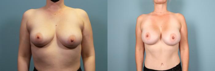 Before & After Breast Augmentation Case 377 Front View in Portland, OR
