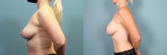 Before & After Breast Augmentation Case 377 Left Side View in Portland, OR
