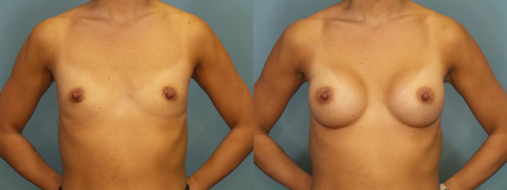 Before & After Breast Augmentation Case 393 Front View in Portland, OR