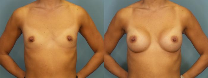 Before & After Breast Augmentation Case 393 Front View in Portland, OR
