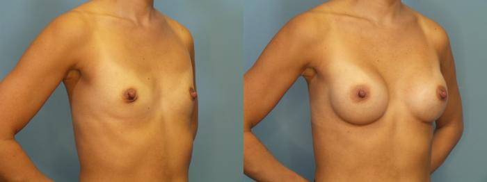 Before & After Breast Augmentation Case 393 Right Oblique View in Portland, OR