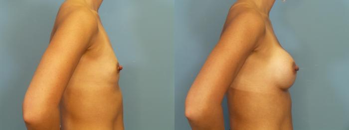 Before & After Breast Augmentation Case 393 Right Side View in Portland, OR