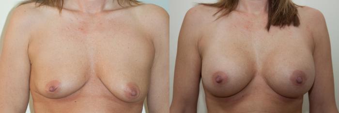 Before & After Breast Augmentation Case 4 View #1 View in Portland, OR