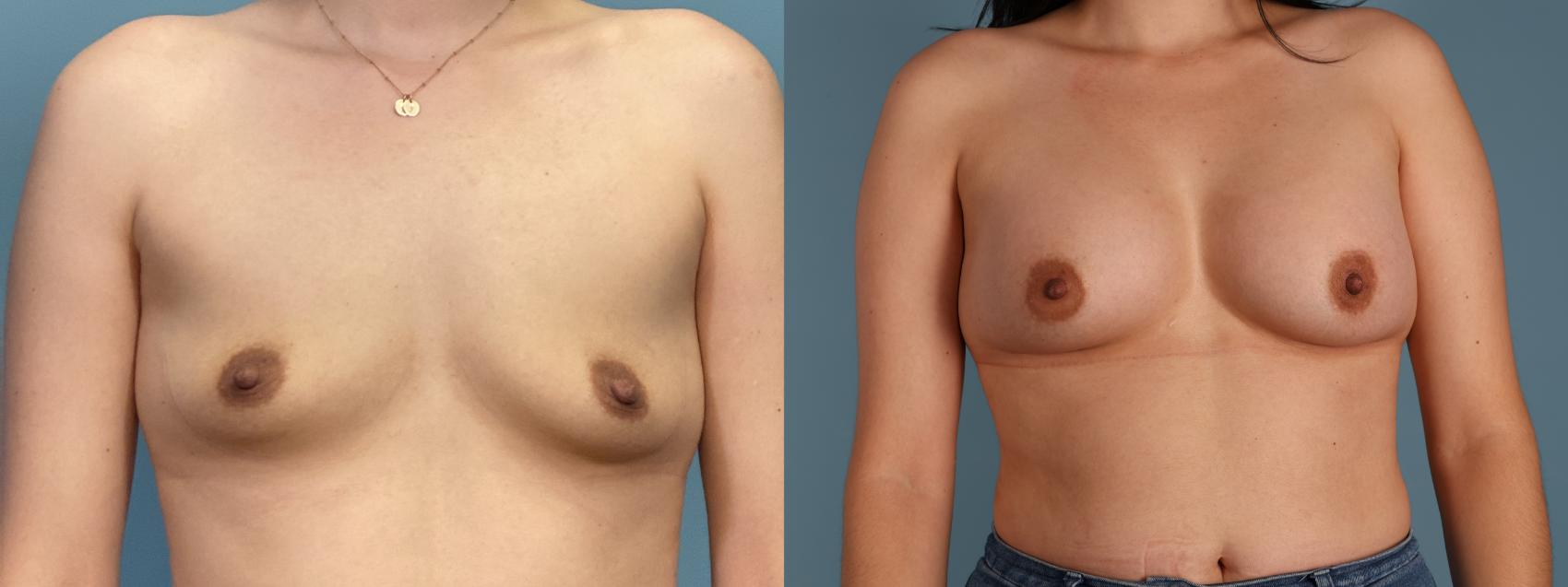 Before & After Breast Augmentation Case 411 Front View in Portland, OR