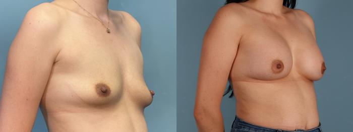 Before & After Breast Augmentation Case 411 Right Oblique View in Portland, OR