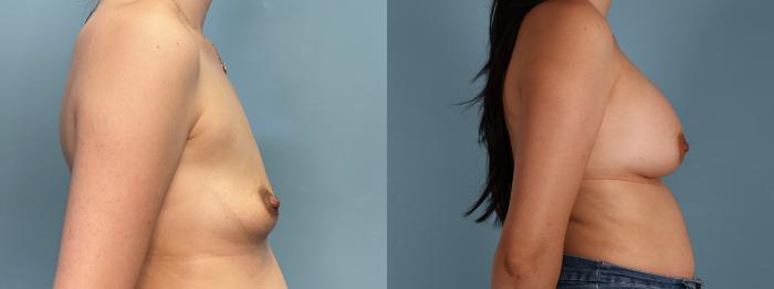 Before & After Breast Augmentation Case 411 Right Side View in Portland, OR