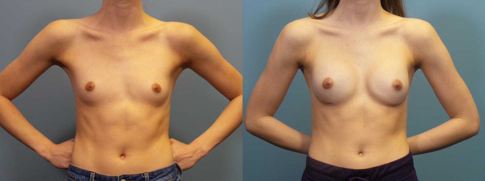 Before & After Breast Augmentation Case 413 Front View in Portland, OR