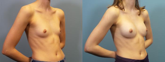 Before & After Breast Augmentation Case 413 Left Oblique View in Portland, OR