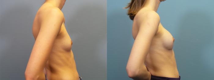 Before & After Breast Augmentation Case 413 Left Side View in Portland, OR