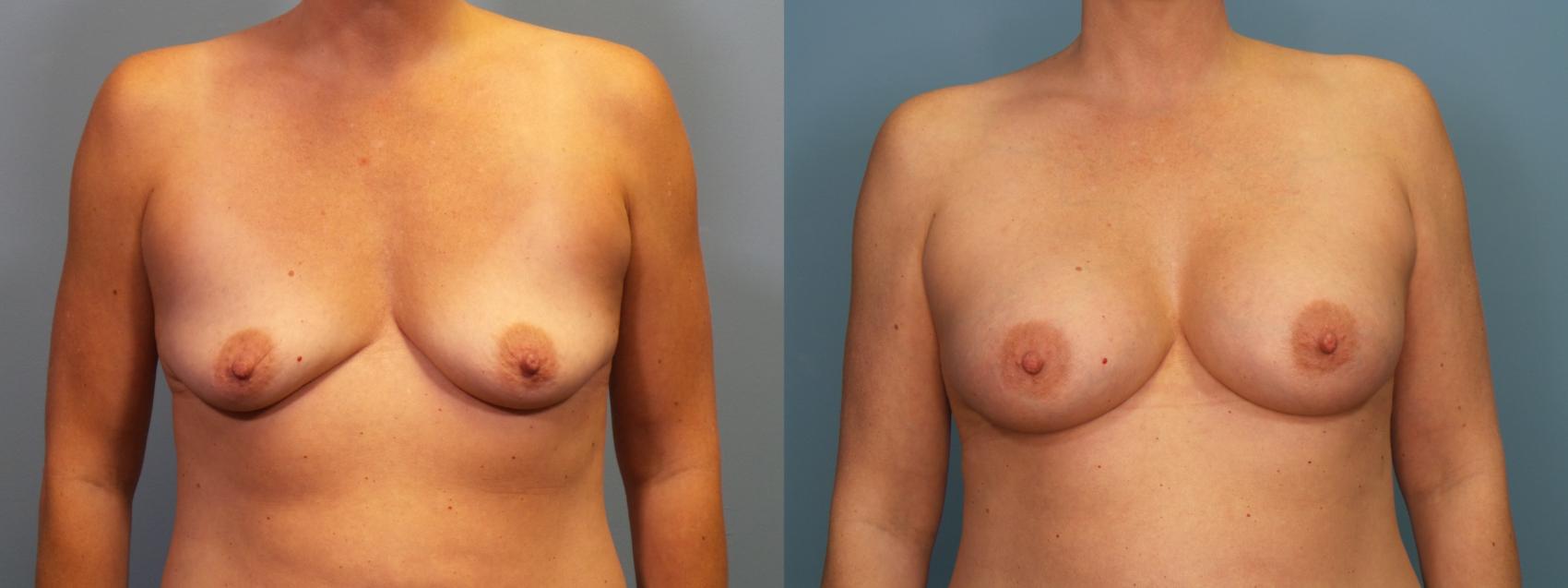 Before & After Breast Augmentation Case 417 Front View in Portland, OR
