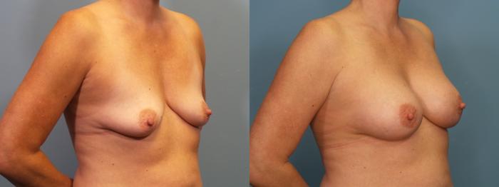 Before & After Breast Augmentation Case 417 Right Oblique View in Portland, OR