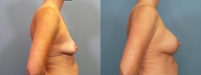 Before & After Breast Augmentation Case 417 Right Side View in Portland, OR