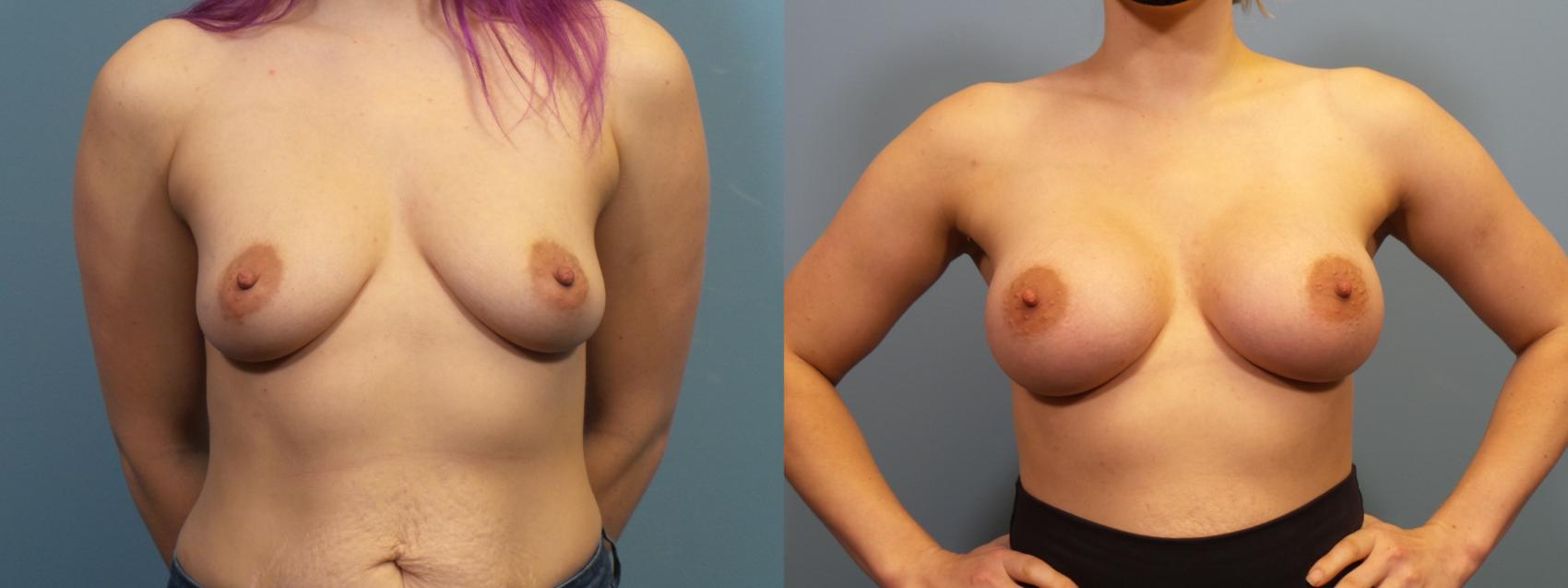 Before & After Breast Augmentation Case 423 Front View in Portland, OR