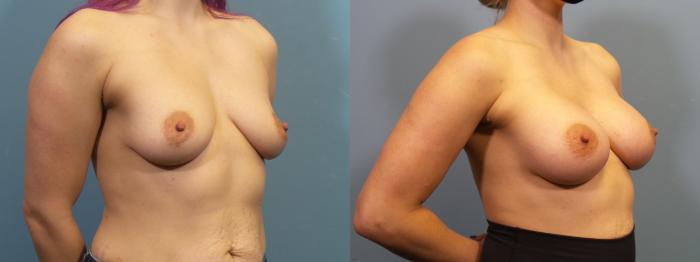 Before & After Breast Augmentation Case 423 Right Oblique View in Portland, OR