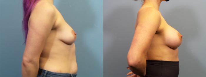 Before & After Breast Augmentation Case 423 Right Side View in Portland, OR
