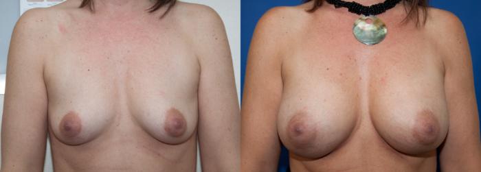 Before & After Breast Augmentation Case 5 View #1 View in Portland, OR