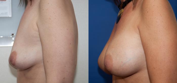 Before & After Breast Augmentation Case 5 View #2 View in Portland, OR