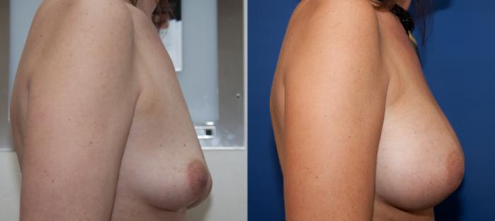 Before & After Breast Augmentation Case 5 View #3 View in Portland, OR