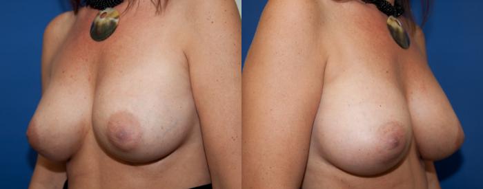 Before & After Breast Augmentation Case 5 View #4 View in Portland, OR