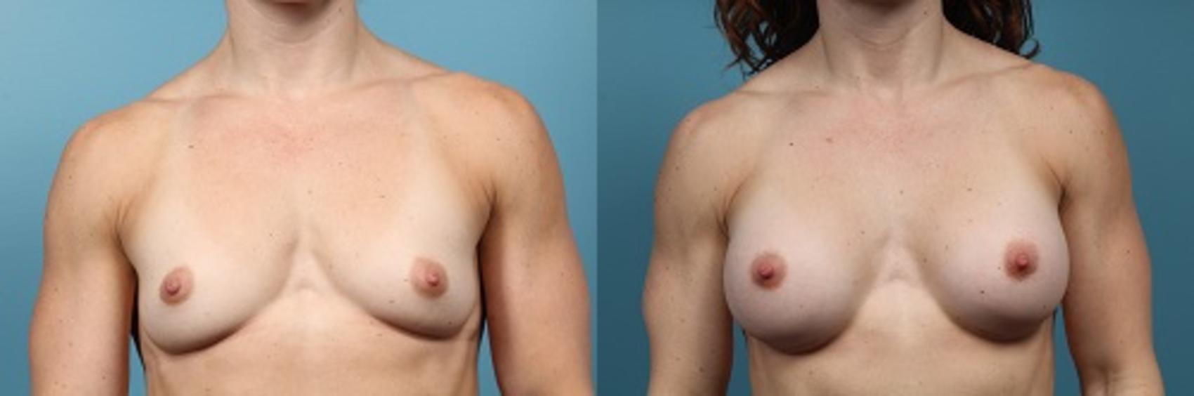 Before & After Breast Augmentation Case 53 View #1 View in Portland, OR