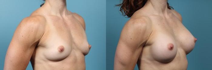 Before & After Breast Augmentation Case 53 View #2 View in Portland, OR