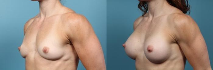 Before & After Breast Augmentation Case 53 View #3 View in Portland, OR