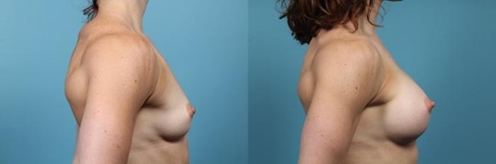 Before & After Breast Augmentation Case 53 View #4 View in Portland, OR