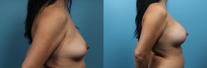 Before & After Breast Augmentation Case 68 View #3 View in Portland, OR