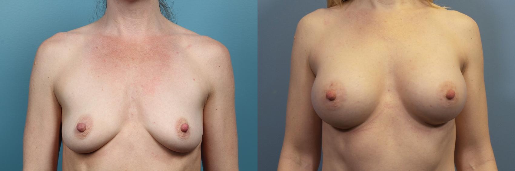 Before & After Breast Augmentation Case 72 View #4 View in Portland, OR