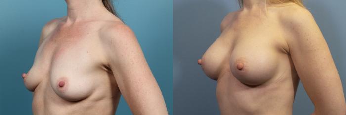 Before & After Breast Augmentation Case 72 View #5 View in Portland, OR