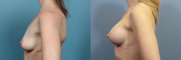 Before & After Breast Augmentation Case 72 View #6 View in Portland, OR