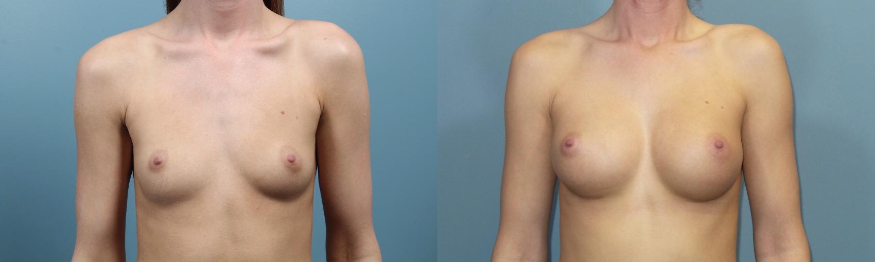 Before & After Breast Augmentation Case 96 View #1 View in Portland, OR