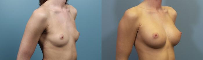 Before & After Breast Augmentation Case 96 View #2 View in Portland, OR