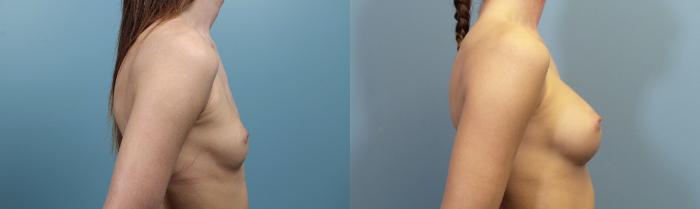 Before & After Breast Augmentation Case 96 View #3 View in Portland, OR
