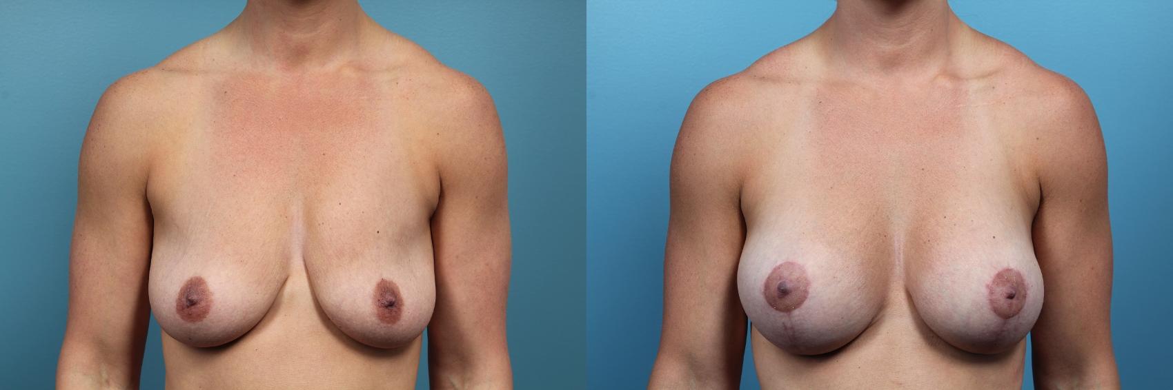 Before & After Breast Lift Case 98 View #1 View in Portland, OR