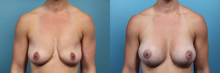 Before & After Breast Augmentation Case 98 View #1 View in Portland, OR