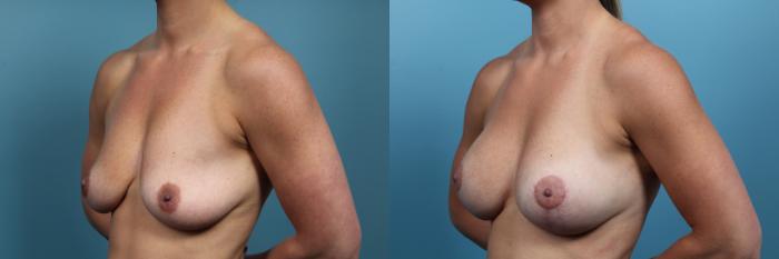 Before & After Breast Augmentation Case 98 View #2 View in Portland, OR
