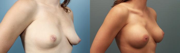 Before & After Breast Augmentation Case 99 View #2 View in Portland, OR