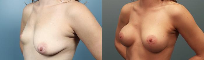Before & After Breast Augmentation Case 99 View #3 View in Portland, OR